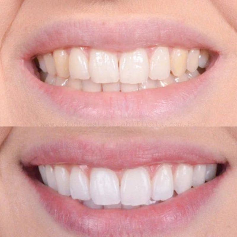 SmilePure™ For Radiantly White Teeth and Healthy Gums