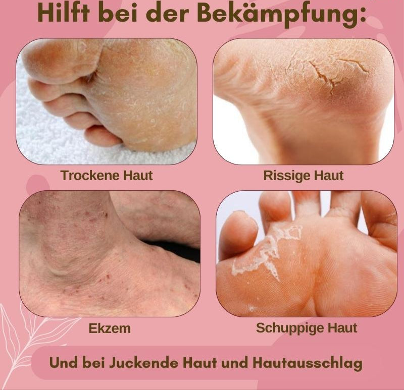 Foot Care Cream | SoleSerum | Anti-Fungal & Moisturizing Skin Treatment with Salicylic Acid