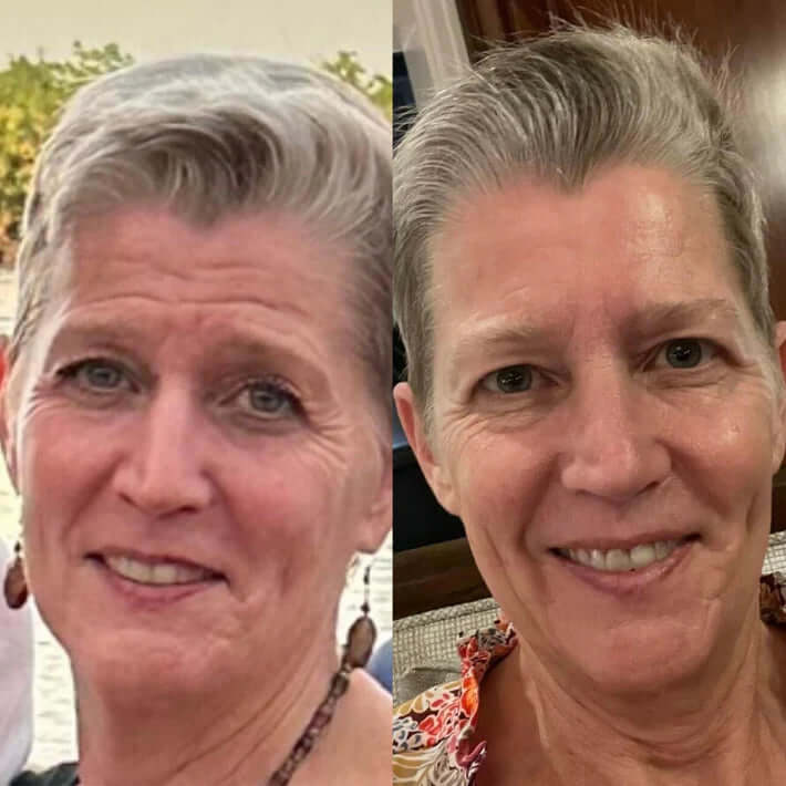 Reusable Anti-Wrinkle Face Patches | Silicone Wrinkle Pads for Forehead, Eyes & Smile Lines