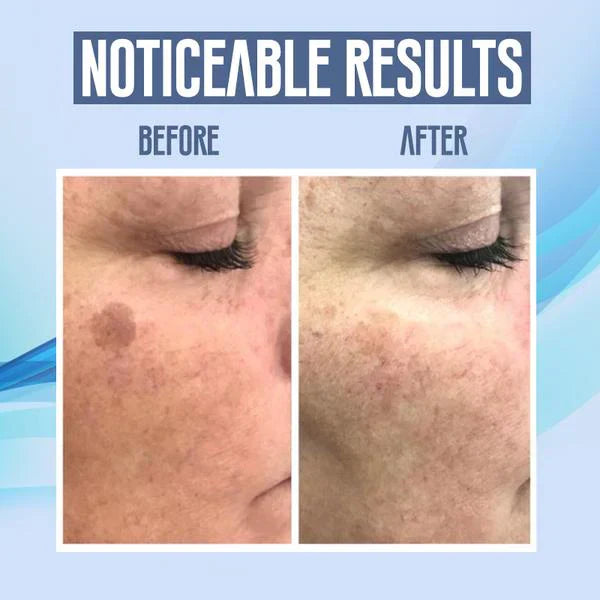 SpotClear™ Dark Spot Vanisher in just Few Weeks