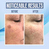 SpotClear™ Dark Spot Vanisher in just Few Weeks