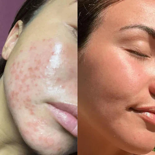 LumiGlow™ - Pain-Free Treatment: Non-Invasive Therapy