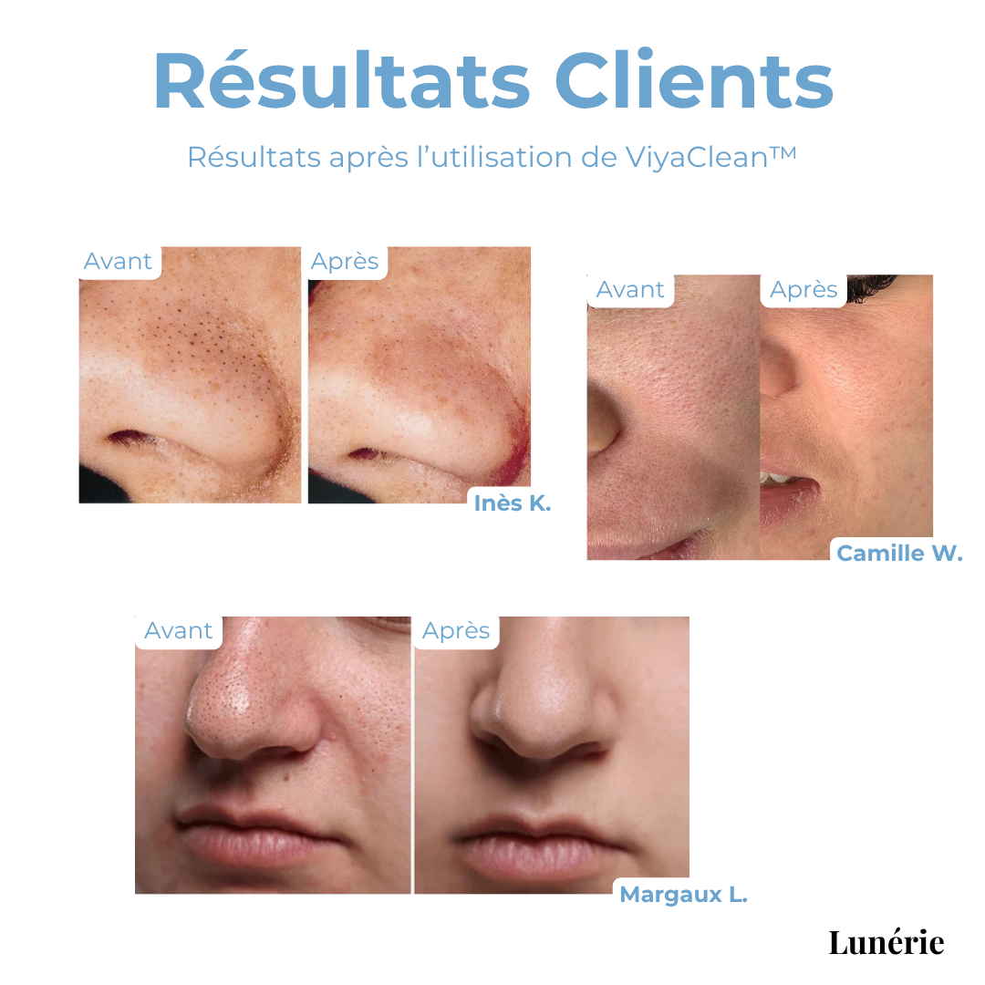 Blackhead Removal Treatment | Pore Cleansing Serum with Salicylic Acid & Natural Extracts