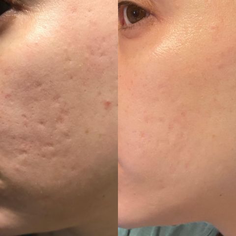 Reusable Anti-Wrinkle Face Patches | Silicone Wrinkle Pads for Forehead, Eyes & Smile Lines