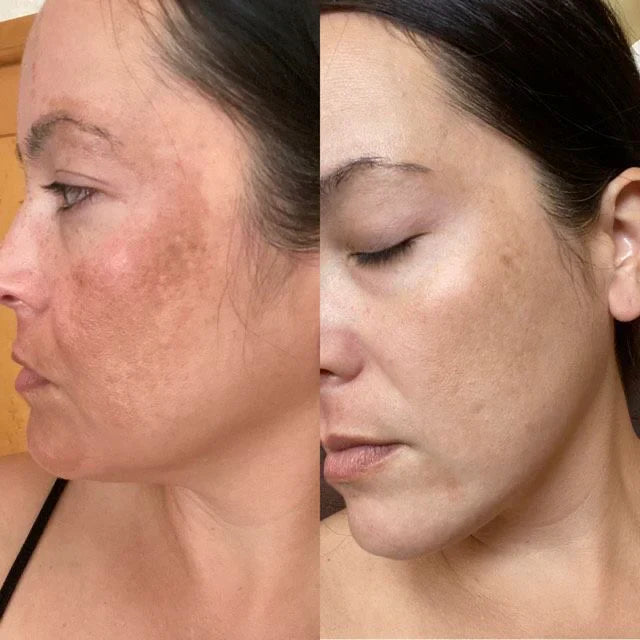 LumiGlow™ - Pain-Free Treatment: Non-Invasive Therapy
