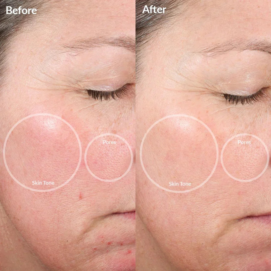 4-in-1 Lumi Lift™ - improve your skin in 2 days with LED and EMS light therapy