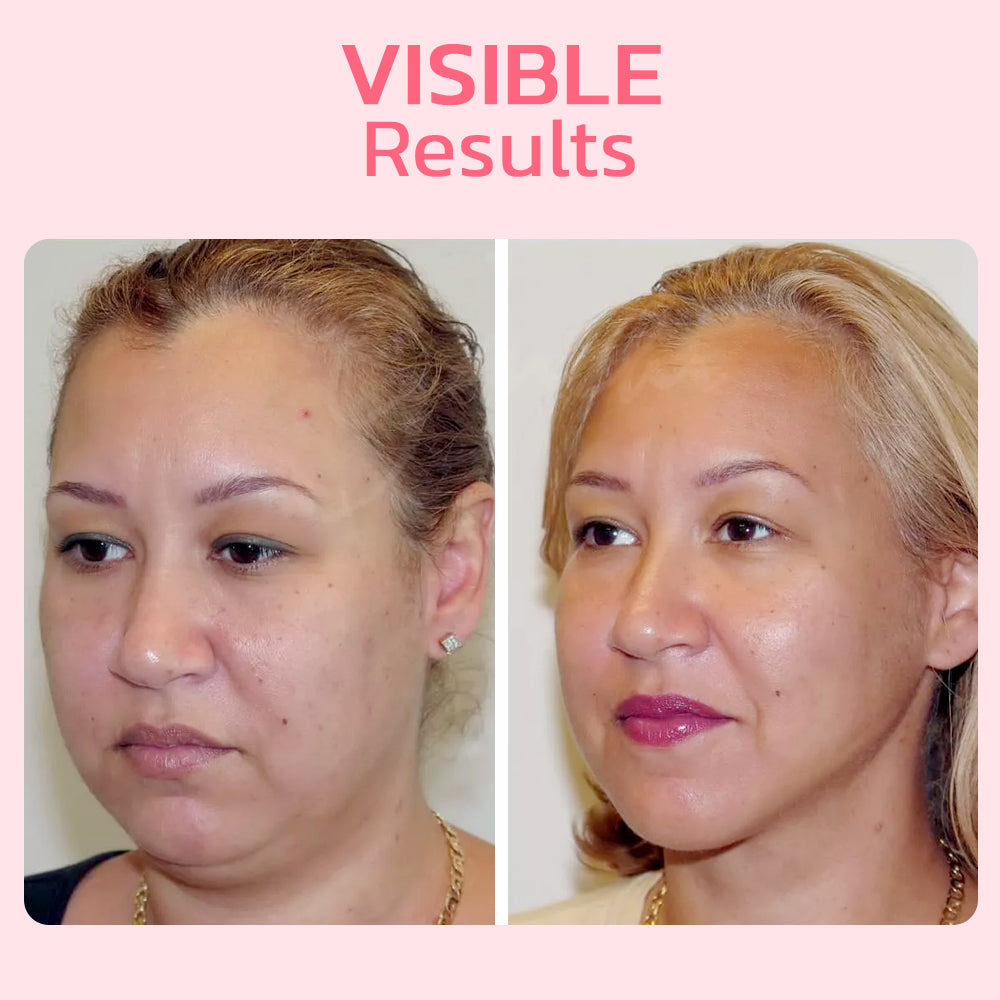 FaceSuction™ Enhanced Facial Definition