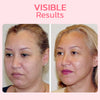 FaceSuction™ Enhanced Facial Definition