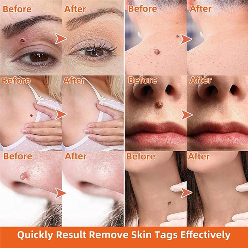 Auto Skin Tag Remover Painless