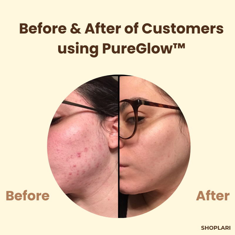 TeaTherapy™ Soothing Skin Relief in just Few Weeks
