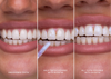 SmileGloss™ Instant Bright Teeth Effect