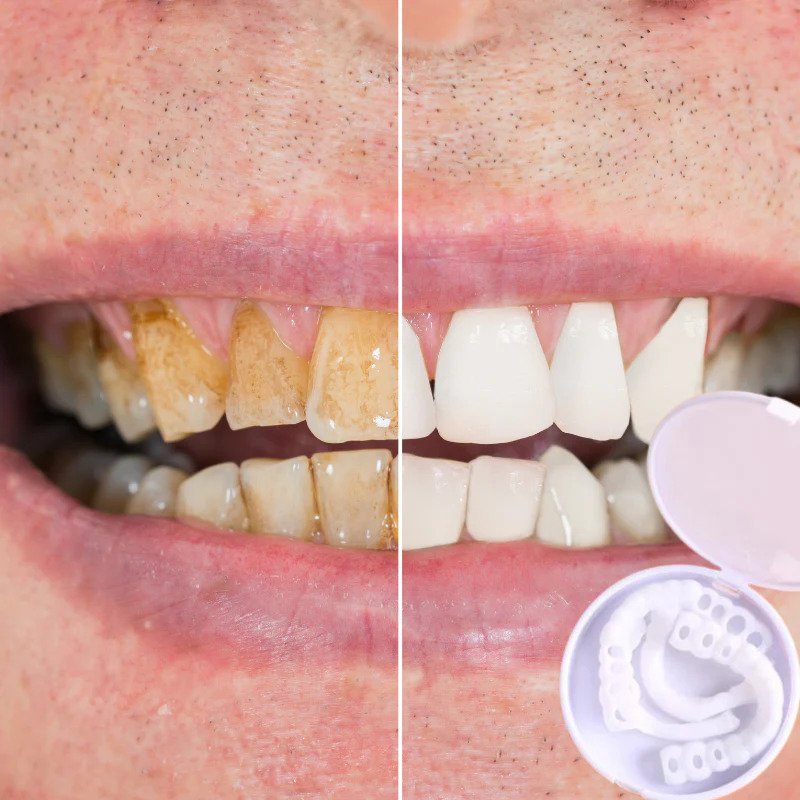 Snap-on Teeth™ - With these veneers, always have the perfect smile