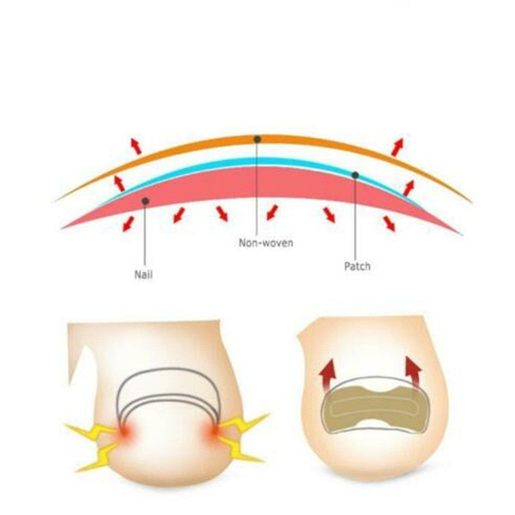 Painless Toenail Patch - ToenailExpress™